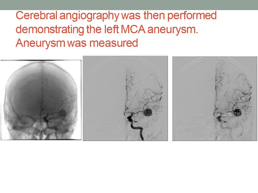 Cerebral angiography was then performed demonstrating the left MCA aneurysm. Aneurysm was measured